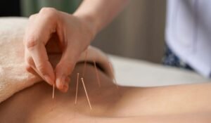 What Is Acupuncture? Benefits for Natural Pain Relief Today