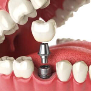 Benefits of Dental Implants for Missing Teeth