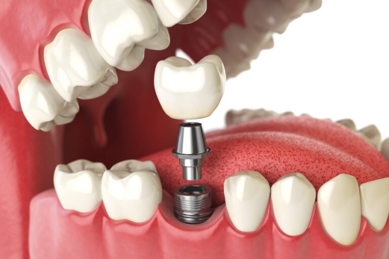 Benefits of Dental Implants for Missing Teeth