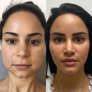 Jawline Botox Before and After: Visible Face Contouring