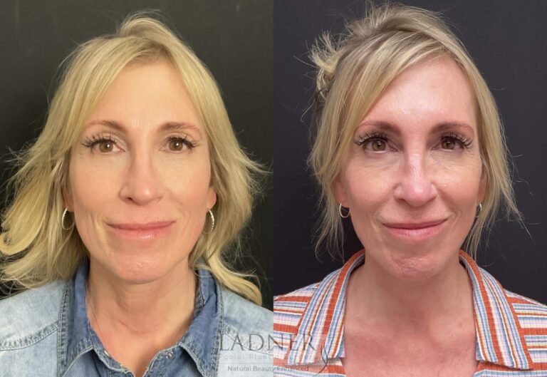 Top Benefits of Double Jaw Surgery for Facial Balance and Breathing