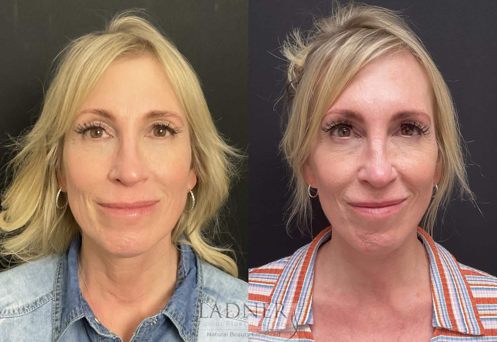 Top Benefits of Double Jaw Surgery for Facial Balance and Breathing